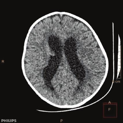 Prezentujemy przypadek 8-miesięcznego niemowlęcia z atypowym guzem teratoidnym rabdoidnym (ang. atypical teratoid rhabdoid tumor AT/RT), umiejscowionym w rdzeniu kręgowym na poziomie C4-C8.