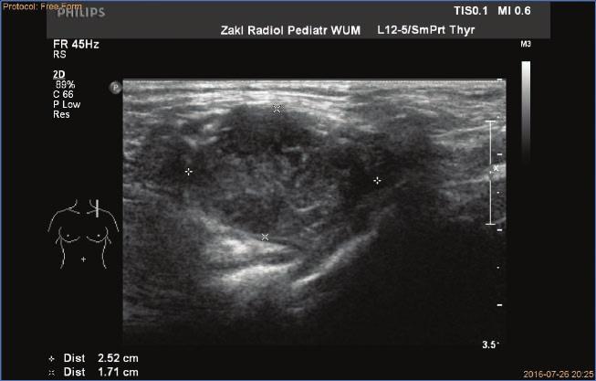 Omawiamy diagnostykę różnicową zmian guzowatych na szyi i przyczyn porażenia splotu barkowego u niemowląt i prezentujemy obraz rzadkiego guza, jakim jest AT/RT.