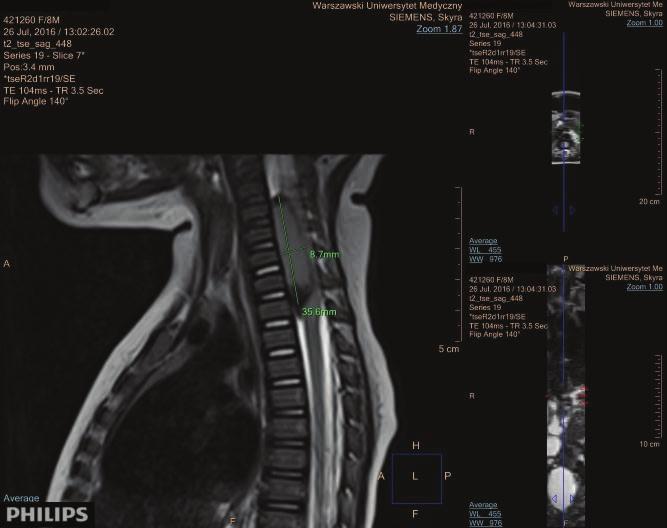 Porażenie splotu barkowego u niemowlęcia jako objaw guza kanału kręgowego opis przypadku Ryc. 4. Wewnątrzkanałowy guz w obrazach T2-zależnych rezonansu magnetycznego Ryc. 5.