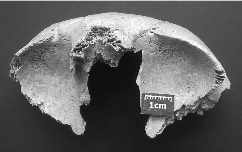 Beata Borowska-Strugińska Fig. 1. Radom grave 19, cribra orbitalia in an orbit of a child, aged 5-6. Photo B. Borowska-Strugińska. orientation.