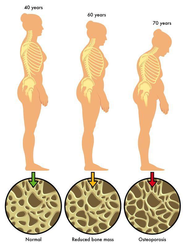 Błonnik a osteoporoza Najczęstszymi czynnikami w etiologii osteoporozy są: niskie spożycie wapnia i niedobór estrogenów.