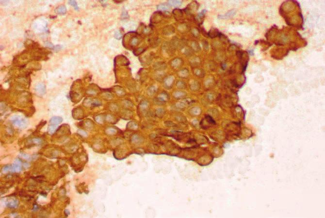 Prace poglądowe Ryc. 3. Obraz cytopatologiczny gruczolakoraka gruczołu sutkowego z rozsiewem do jamy klatki piersiowej u psa widać silną ekspresję cytokeratyny (barwa brązowa).