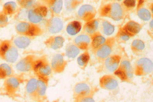 barwnikotwórczej lub też gdy wykazuje cechy złośliwości cytologicznej, czy jest komórką raka (ryc. 3), mięsaka lub czerniaka.