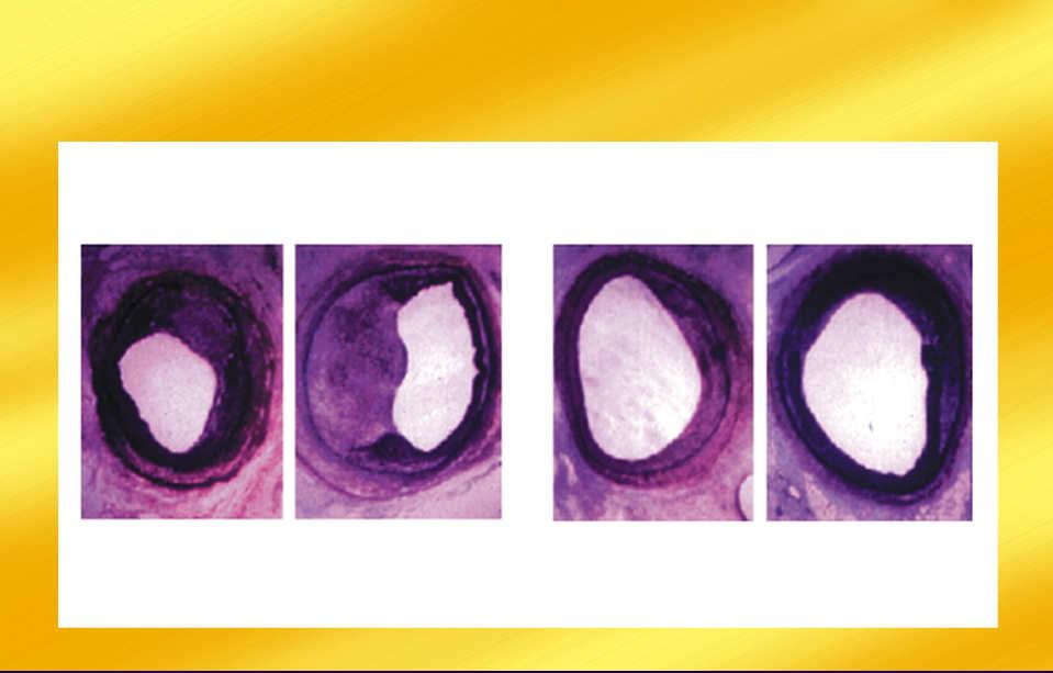 Inhibitory mtor syrolimus, ewerolimus Hamowanie proliferacji VSMCs po uszkodzeniu ściany naczyniowej Przeciwciała blokujące receptory limfocytów T bazyliksimab Bazyliksimab monoklonalne przeciwciało