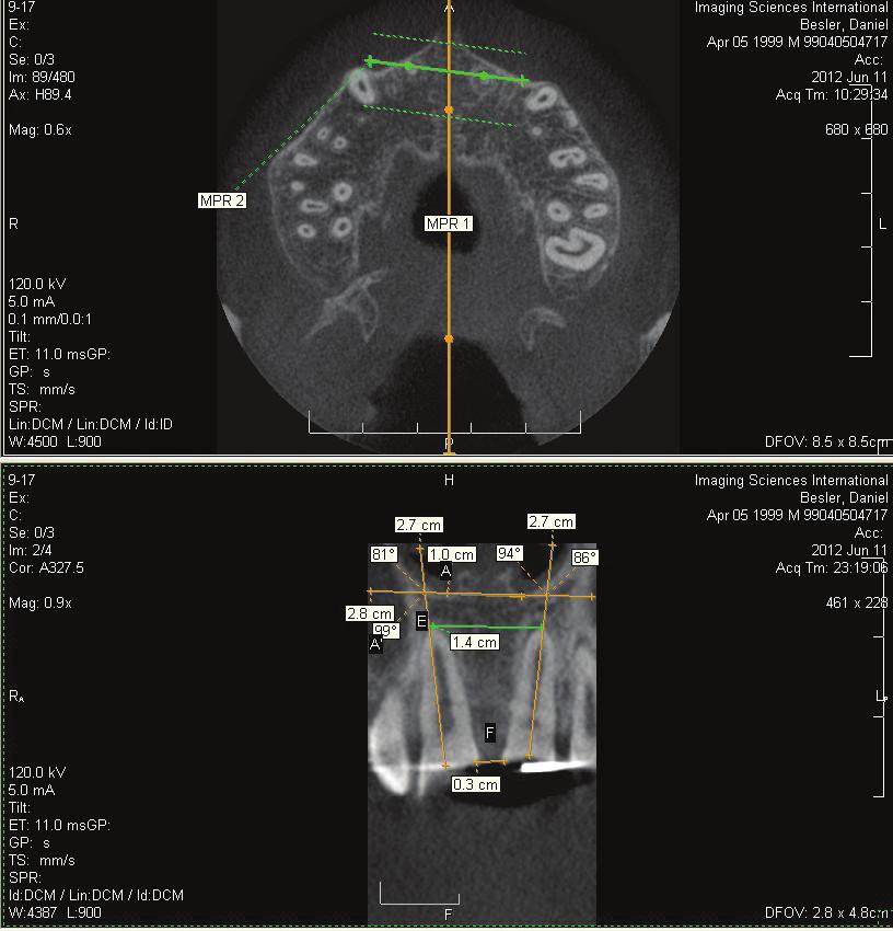 Please note the buccal torque of the tip of the roots with the relatively unchanged position of the crown portions.