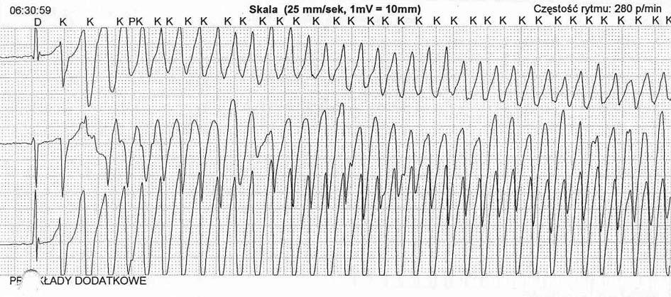 Polimorficzny częstoskurcz rozpoczyna się po wczesnym pobudzeniu