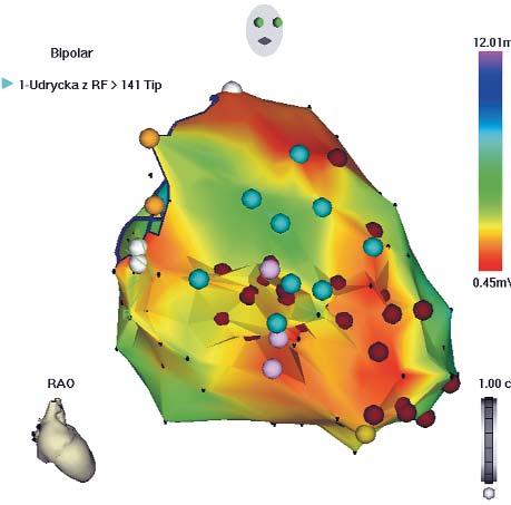 Ablacja katecholaminergicznego wielokształtnego częstoskurczu komorowego z włókien Purkinjego opis przypadku 325 Rycina 6. Mapa elektroanatomiczna potencjałowa lewej komory.