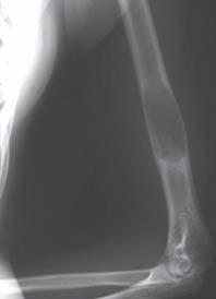 Specifics of diagnosis and therapy of bone tumors in children image of osteochondroma and osteophyte usually leaves no doubts.