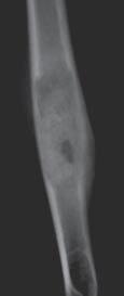 [15] In children, the activity of the process may great and the microscopic image may suggest a malignancy. 77 we, towarzyszące zwykle zmianom rozległym.