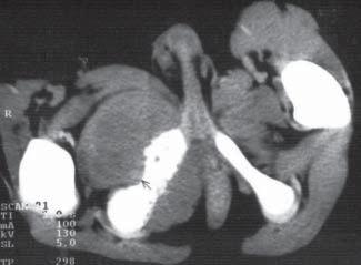 78 E. KULETA-BOSAK, E. KLUCZEWSKA, W. MADZIARA, J. MACHNIK-BRONCEL The prognosis in benign tumors is good, despite frequent recurrences, particularly in the case of cysts.