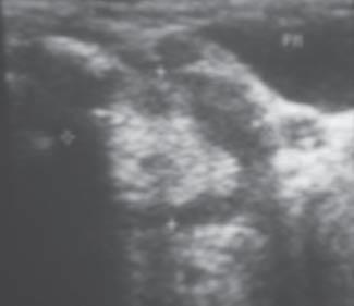 Malignant bone tumors in children continue to be a serious diagnostic problem. We still encounter cases of a late diagnosis.
