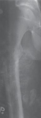 Specifics of diagnosis and therapy of bone tumors in children mi rozpoznawanymi za późno.
