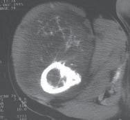 prawidłowej ocenie klinicznej i radiologicznej zmian wynikający z rzadkiego ich występowania.