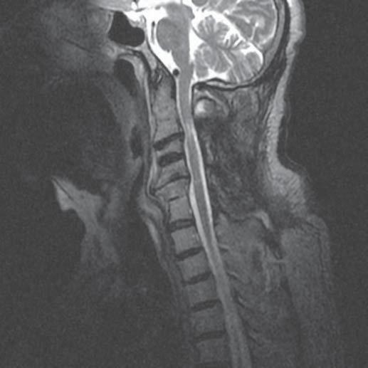 In one patient, during the observation period, a left-side paresis appeared, which subsided after conservative treatment.