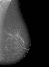 mammograficznej z obrazów 3D tomosyntezy.