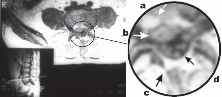 the surgery revealed, in 72.5% of cases, the presence of tissue of a signal similar to that from the nucleus pulposus or a scar on the anterior wall of the spinal canal.