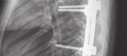 Stabilization of the spine involves functional spinal units between the stable