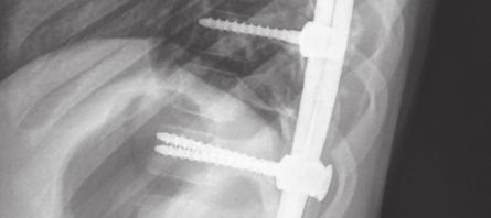 Longer ends of the rods are left caudally and cephalically to the farthest pedicle