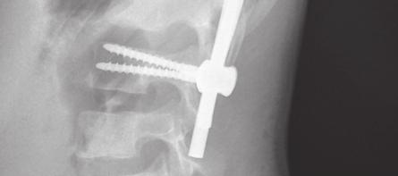 The patients did not require additional external stabilization with corrective