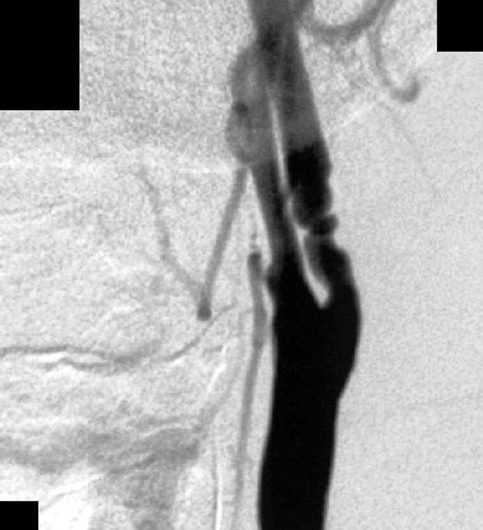 Ryszard Staniszewski et al. Carotid restenosis Polish Surgery 2005, 7, 2 Przezskórną angioplastykę tętnicy szyjnej z założeniem stentu wykonano u 14 chorych.