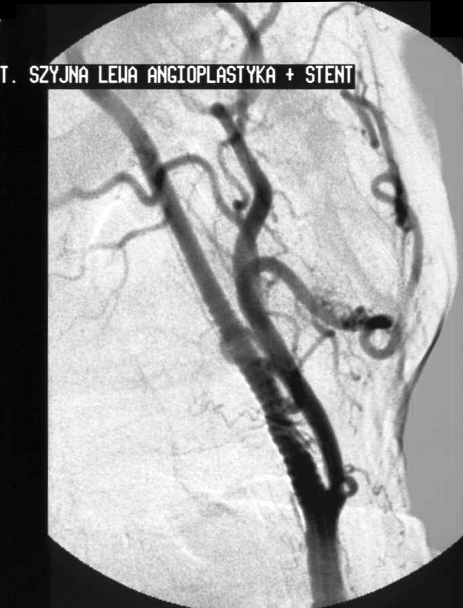 Angioplastyka lewej tętnicy szyjnej wewnętrznej stan przed PTA, przypadek 2 Figure