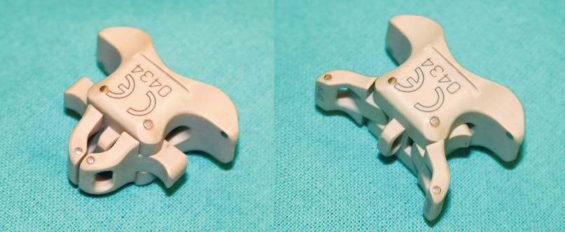 inswing interspinous spacer in the treatment of lumbar disc diseases 81 sięcy po operacji oraz rtg boczne wykonywane przed, 3 i 12 miesięcy po operacji.