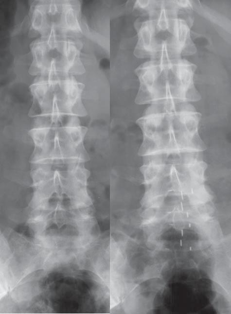 84 D. ZARZYCKI, A. SMĘTKOWSKI, J. LASOTA, P. RADŁO, J. ADAMCZYK OUTCOMES Size of herniation estimated in NMR study decreased in almost all patients(48/51) on average 33%. (FIG.