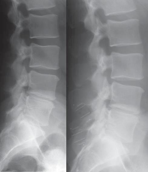In the case of 2 patients hernia did not decrease, nevertheless these patients reported good pain relief. Disc recovery (Return of white color on NMR T2 scans) was observed at 30% patients.