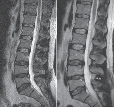 inswing interspinous spacer in the treatment of lumbar disc diseases POWIKŁANIA Powikłania śródoperacyjne wystąpiły u 2 chorych: 1 pacjent - złamanie wyrostka kolczystego podczas wprowadzania
