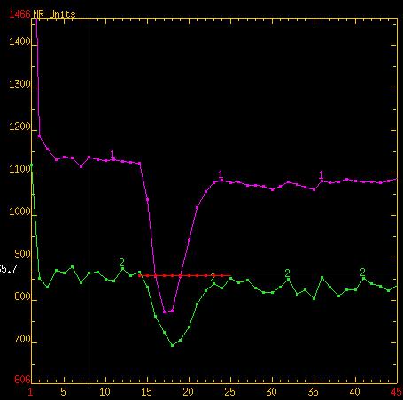 CBV cerebral blood volume CBF