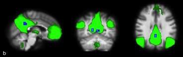 fmri spoczynkowy (resting state) zaburzenie funkcji sieci neuronalnych,