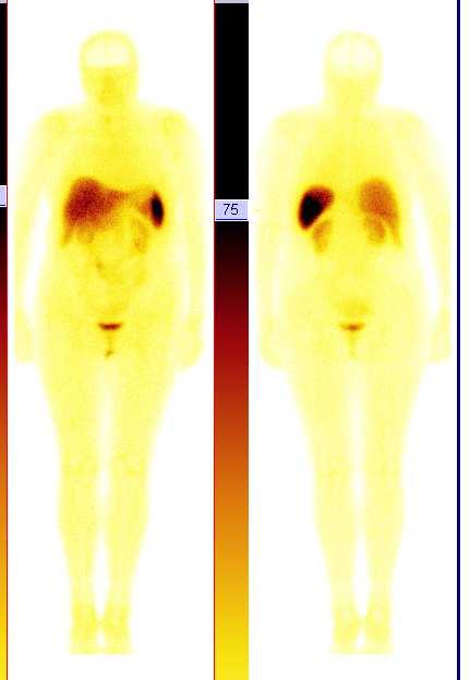 RadionuclideTherapy, PRRT)