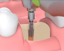 Implantacja pod kontrolą Automatyczna kontrola ustawionego momentu obrotowego gwarantuje bezpieczeństwo