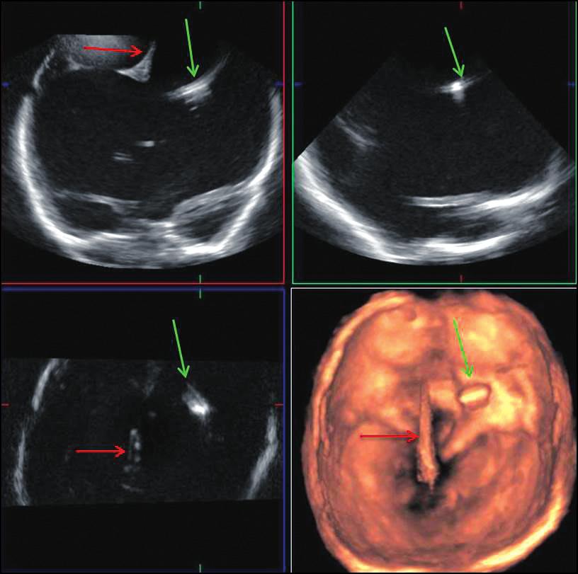 Usefulness of 3D sonography of the central nervous system in neonates and infants in the assessment of intracranial bleeding and its consequences when examined through the anterior fontanelle Ryc. 4.
