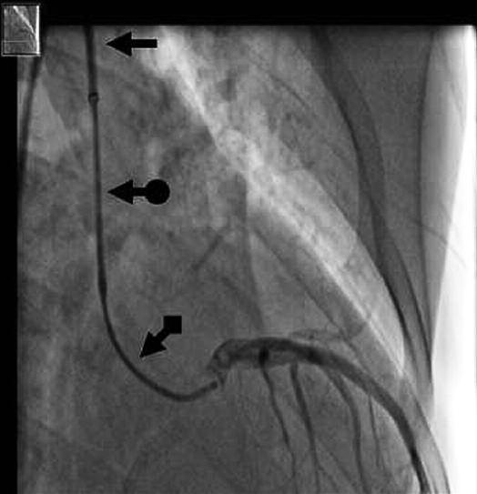 Ryc. 1. Selektywna angiografia LTW; strzałka koszulka naczyniowa 90 cm 6 F; strzałka z kropką cewnik prowadzący EU 3.5 6 F; strzałka z kwadratem cewnik diagnostyczny JL4 5 F.