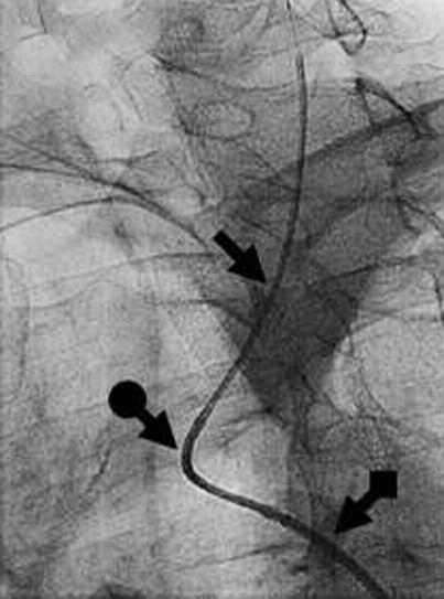 Ryc. 2. ngioplastyka LI z dostępu udowego; strzałka cewnik diagnostyczny JR4 5 F; strzałka z kropką cewnik prowadzący JR4 6 F; strzałka z kwadratem koszulka naczyniowa 90 cm 6 F.