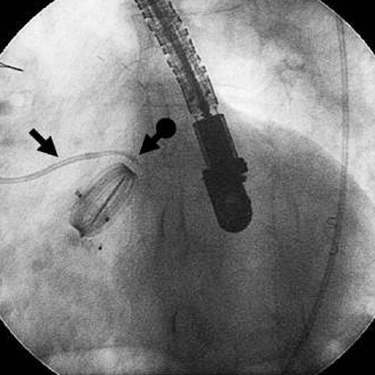 Ryc. 3. Zamknięcie przecieku okołoaortalnego zlokalizowanego w lewej zatoce wieńcowej; strzałka cewnik prowadzący L1 6 F; strzałka z kropką cewnik diagnostyczny JR4 5 F.
