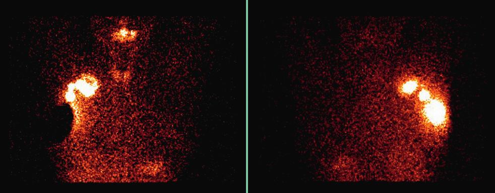Akwizycja planarna a SPECT/CT w detekcji węzłów wartowniczych w raku sutka WSTĘP Biopsja węzła wartowniczego stała się niemalże rutynowym postępowaniem medycznym w przypadku leczenia raka sutka.