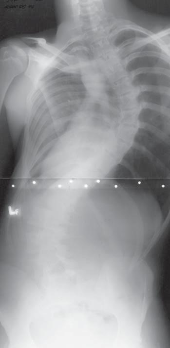 28 B. JASIEWICZ, T. POTACZEK, M. TÊSIOROWSKI re are some differences in top and bottom vertebra localization in comparison to the patients with idiopathic scoliosis (4).