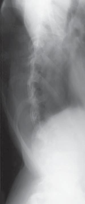 Usually it is stated, that thoracic spine in this group of patients is lordotic; however, Spondeller has shown that in these cases normal kyphosis or hyperkyphosis is also possible.