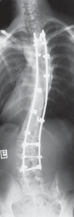 A significant percentage of patients are characterized by impaired sagittal balance and kyphotic thoracolumbar junction (5). In our material, type II according to Sponseller (i.e. with abnormal Th10-L2 localization), was found in as much as 47% of patients.
