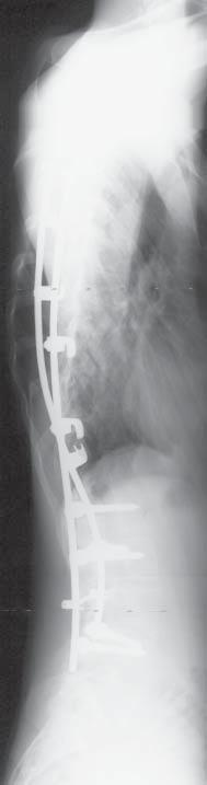 Scoliosis in the course of Marfan syndrome in comparison to idiopathic scoliosis has the tendency to progress before puberty, and angular values of more than 30-40 o can progress even in adults.