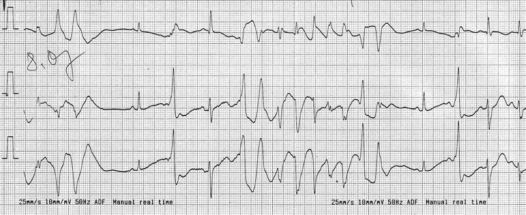 Folia Cardiol. 2005, tom 12, nr 7 I II III Rycina 2. Zapis EKG (odprowadzenia I, II, III) u 15-letniej dziewczynki z zespołem wydłużonego QT z wielokształtnym komorowym częstoskurczem Figure 2.