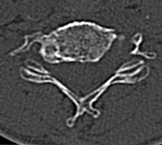 Badania CT i MRI: stenoza zachyłków bocznych po stronie lewej na poziomach C5/C6 i C6/C7 (Fig.1) bez towarzyszącej kompresji rdzenia kręgowego.