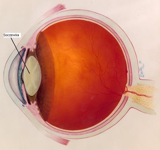 Strona2 Położenie soczewki w oku. KIEDY ZAĆMA WYMAGA LECZENIA OPERACYJNEGO?