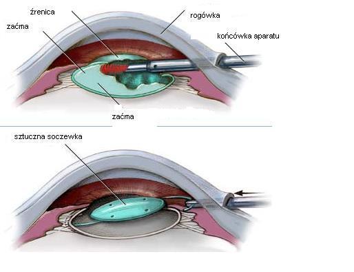 Strona4 Usunięcie zaćmy połączone z wszczepieniem sztucznej soczewki do oka. JAKIE SĄ WYNIKI OPERACJI?