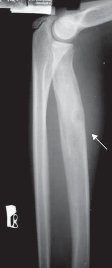 84 E. KLUCZEWSKA, E. KULETA-BOSAK, J. MACHNIK-BRONCEL, D. SOJKA, W. ROGALA, W. MADZIARA Pic. 2. A 12y.o. boy, fracture of radius in history.