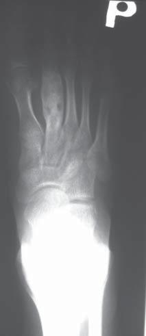 RTG przedramienia: nierówne obrysy, pogrubienie kości promienowej, sklerotyzacja, niejednorodna struktura kości Pic. 3. A 14y.o. girl, a history of 3 months pains after an injury.