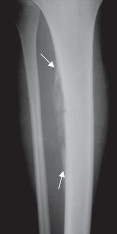 Suitability of imaging techniques in the diagnostics of ostitis in children own experiences 85 DISCUSION Clinical signs of osteomyelitis are not specific and vary depending on children age,