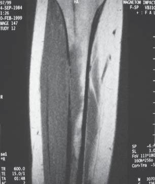 Reactive changes of periosteum can be seen then like benign thickenings, minimal osteolytic foci (Pic.1).